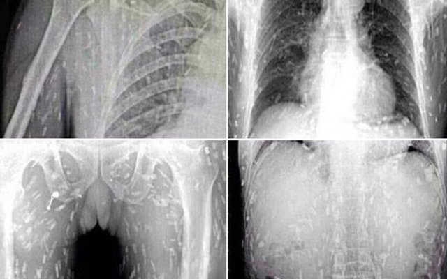 No creer&aacute;s lo que ten&iacute;a este hombre en su cuerpo despu&eacute;s de comer sushi