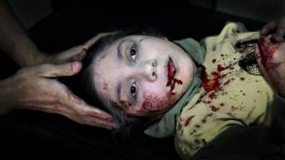 La mirada de una ni&ntilde;a siria herida es "Foto del a&ntilde;o" de Unicef