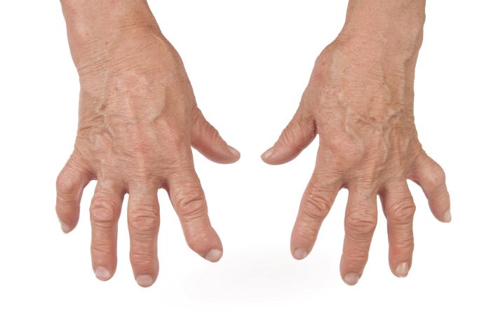 Oficialmente un m&eacute;dico revela la cura natural para la artritis