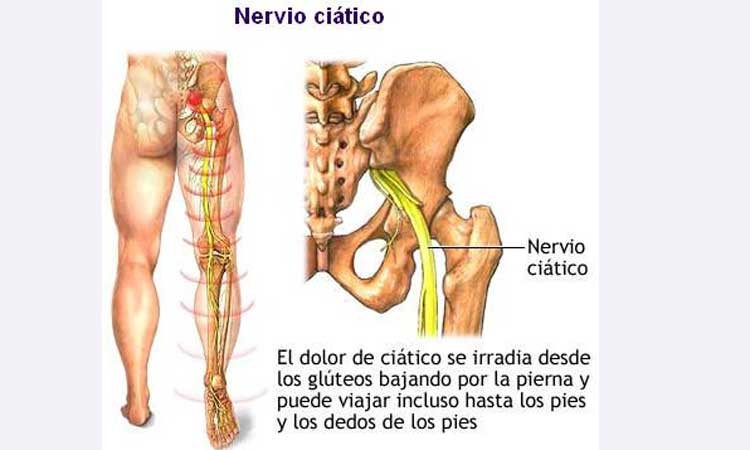 DOLOR  DE CI&Aacute;TICA TRATAMIENTO CASERO