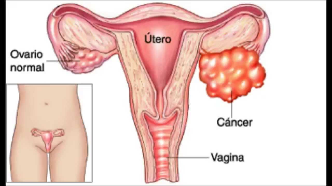  C&aacute;ncer de ovario: s&iacute;ntomas,  diagn&oacute;stico, tratamiento, prevenci&oacute;n