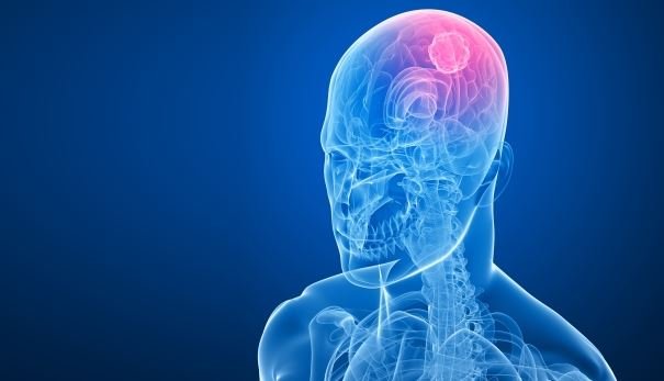 C&aacute;ncer de cabeza y cuello deja m&aacute;s de 20 mil muertos al a&ntilde;o en Am&eacute;rica del Sur y Centro