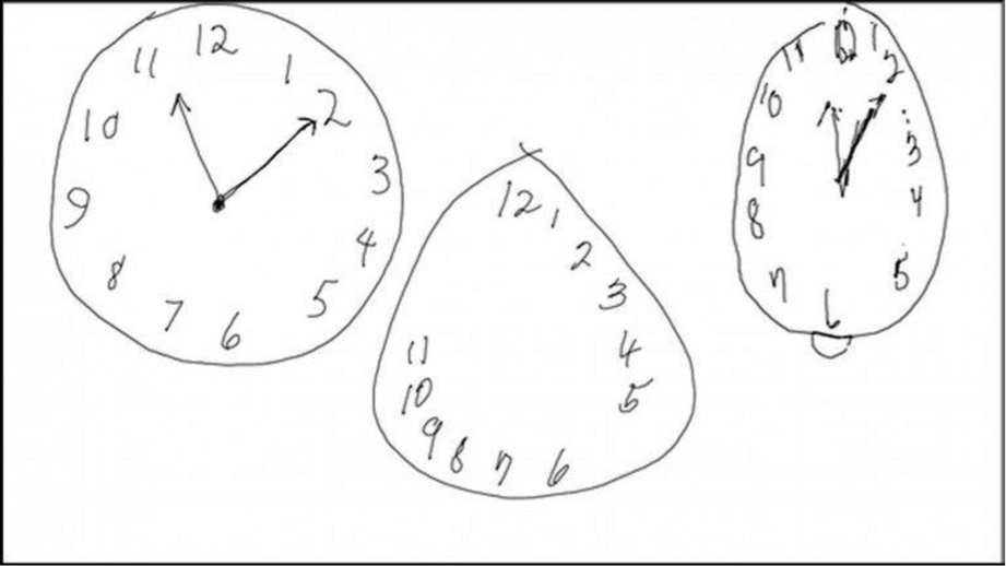 Dibujar un reloj, podr&iacute;a decirte si padeces p&aacute;rkinson o alzh&eacute;imer