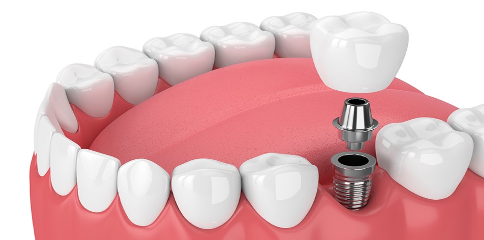 &iquest;Qu&eacute; tipo de implantes dentales puedes hacerte?