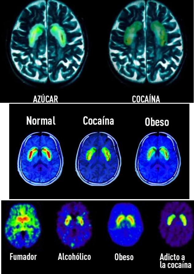 As&iacute; afecta el az&uacute;car el cerebro