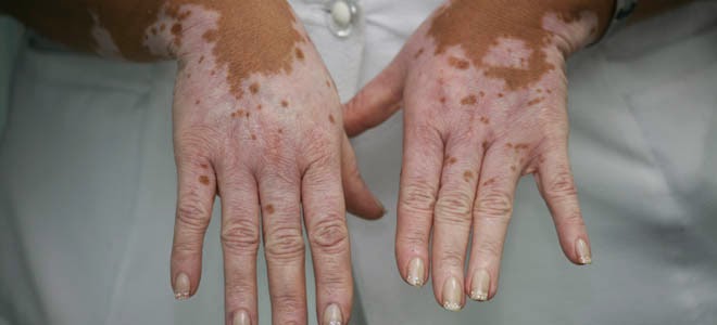 El mundo entero celebra esta noticia:M&eacute;dicos logran cura para el vitiligo