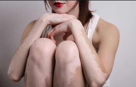 Como Saber si El vitiligo es Curable o No
