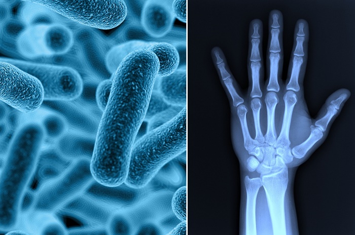 Dolor de articulaciones est&aacute; relacionado con bacterias en el intestino