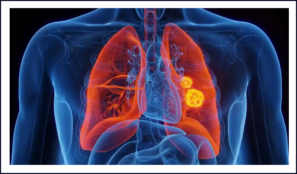  C&aacute;ncer de pulm&oacute;n: Sigue la batalla de la investigaci&oacute;n que no cesa