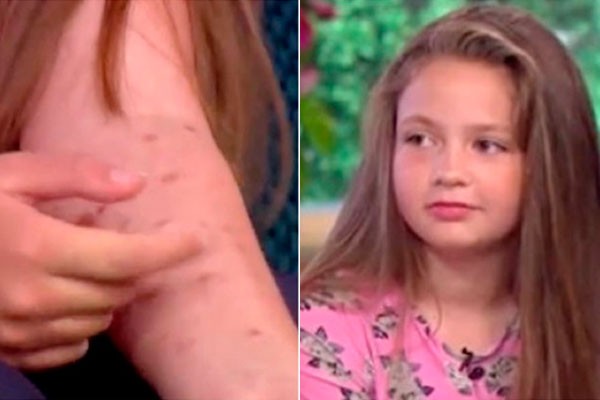 Facebook: ni&ntilde;a sufri&oacute; terribles quemaduras tras aceptar este peligroso reto