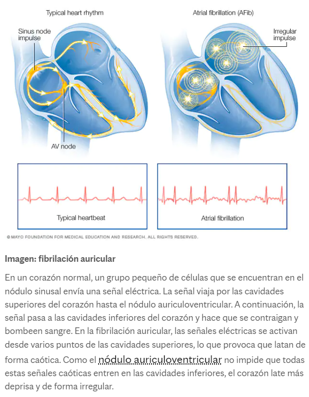  FA - Fibrilaci&oacute;n auricular, riesgos, prevenci&oacute;n y cuidados