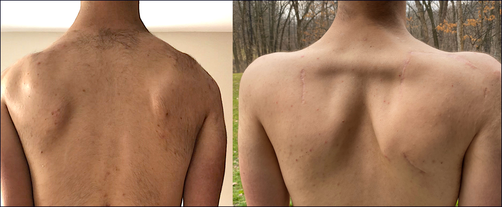  Actividades para quien sufre la FSHD (distrofia facioescapulohumeral)