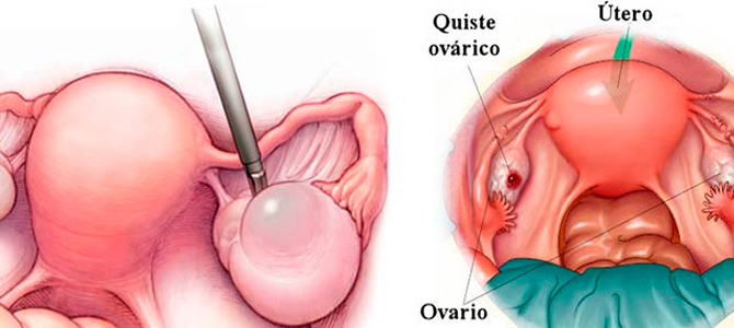 Como eliminar los quistes en los ovarios sin cirug&iacute;as