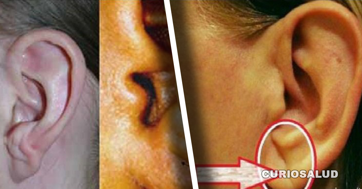 Si tienes esta particularidad en tu oreja, &iexcl;cuidado puedes estar en riesgo de sufrir un infarto!