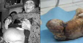 Ella estuvo embarazada por 60 a&ntilde;os, cuando la abrieron encontraron esto.