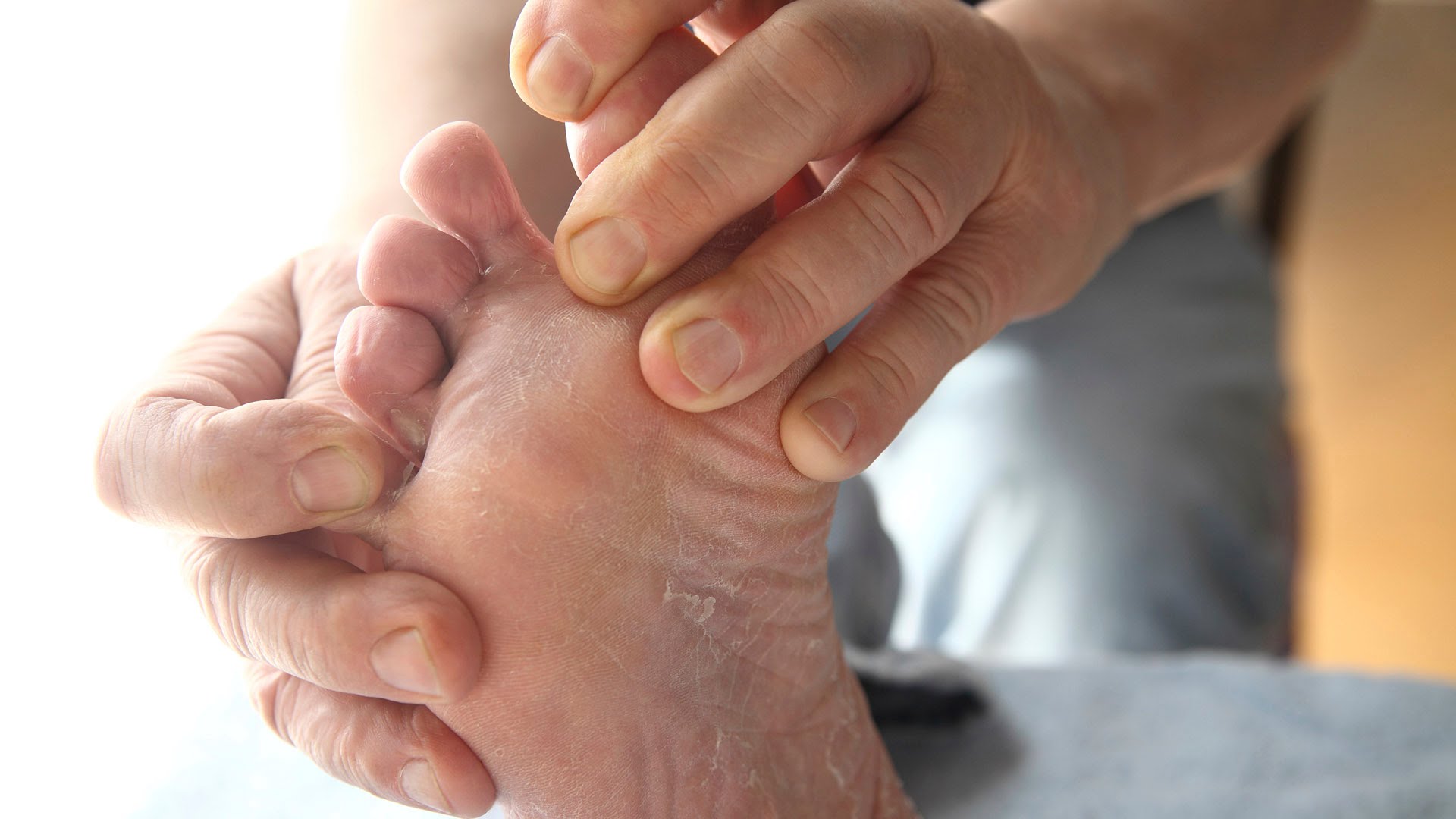 Descubre c&oacute;mo terminar definitivamente con los hongos en los pies