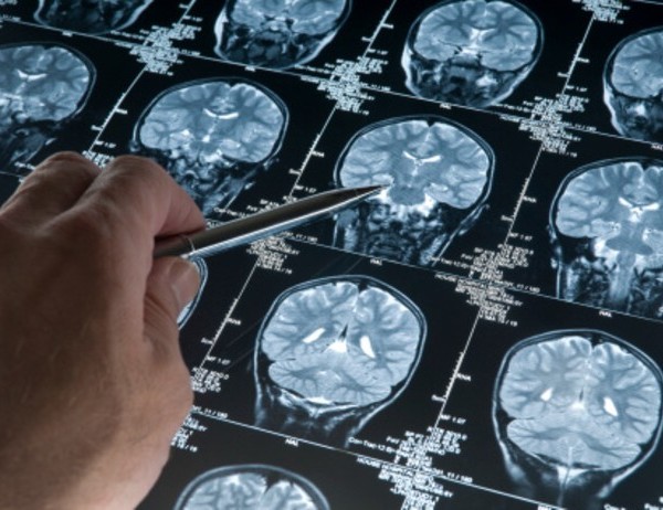 La prote&iacute;na del alzh&eacute;imer comienza a acumularse desde los 20 a&ntilde;os 