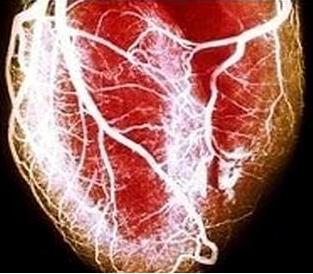 Sindrome del coraz&oacute;n roto