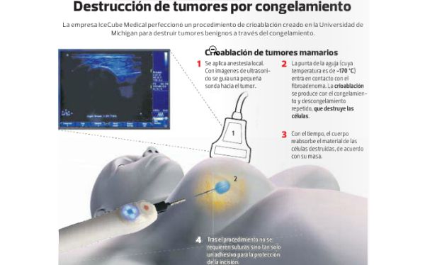 Una t&eacute;cnica que congela los tumores puede servir contra el c&aacute;ncer de mama