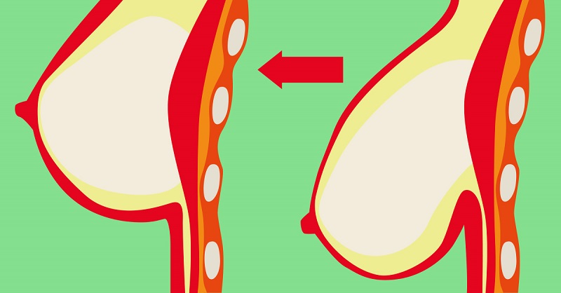 3 trucos que le devolver&aacute;n la forma a tus senos: &iexcl;Remedio efectivo y saludable!
