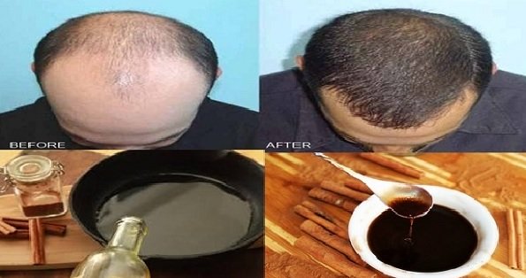 No m&aacute;s p&eacute;rdida de cabello y calvicie: regenera el cabello con esta receta en pocos d&iacute;as