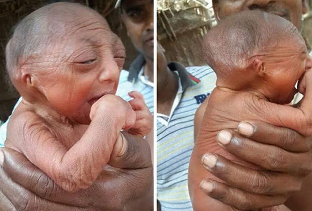 Este beb&eacute; naci&oacute; con el aspecto de un anciano de 90 a&ntilde;os