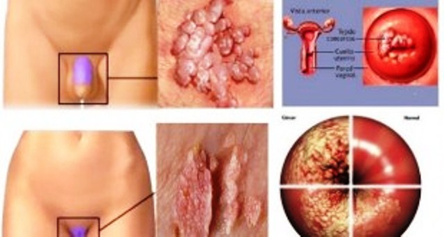 Nueva infecci&oacute;n de transmisi&oacute;n sexual se est&aacute; propagando    muchas personas ya est&aacute;n infectadas