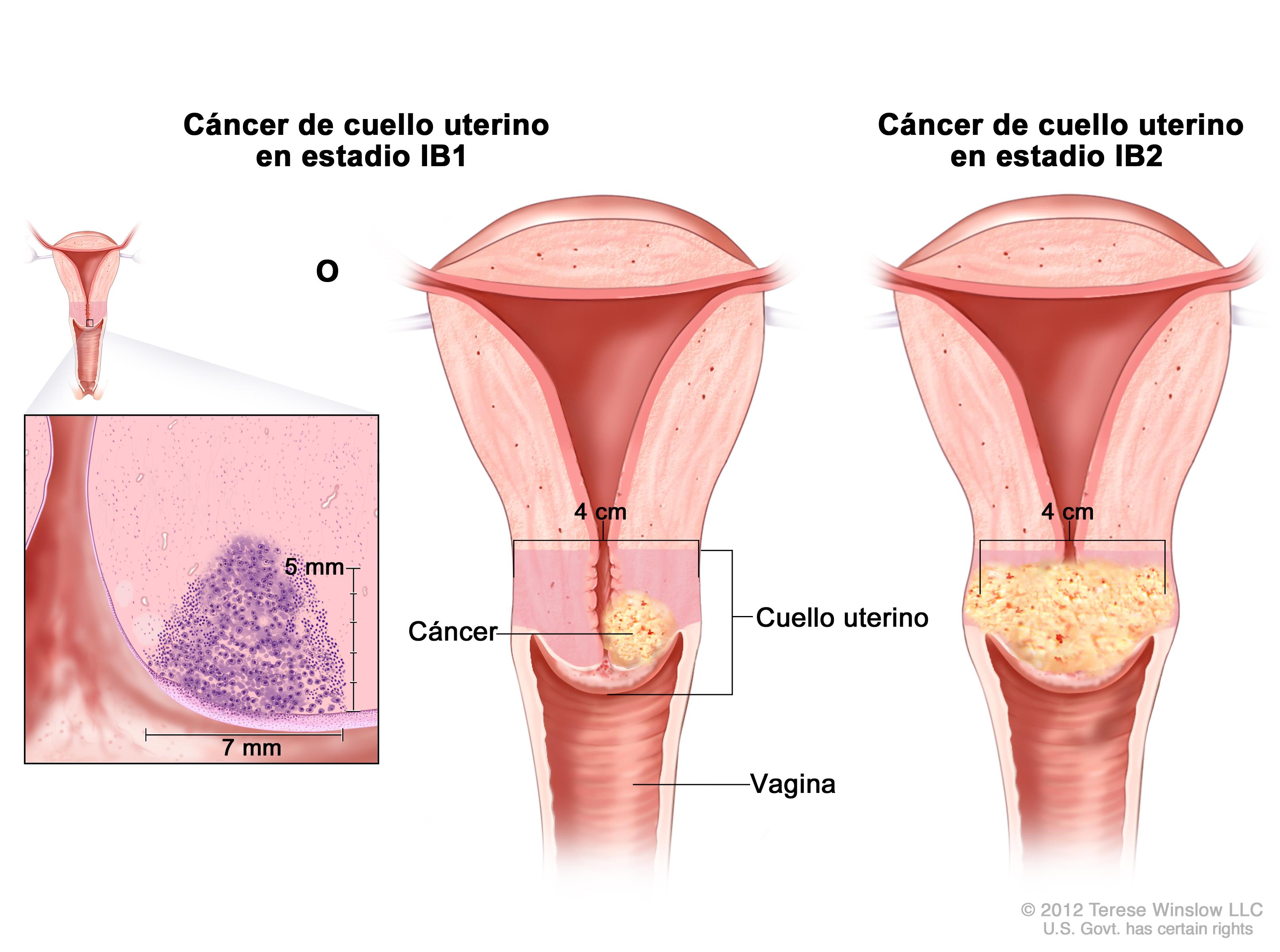 Doctora afirma haber curado muchas pacientes con c&aacute;ncer de &uacute;tero recurriendo estas 3 hierbas