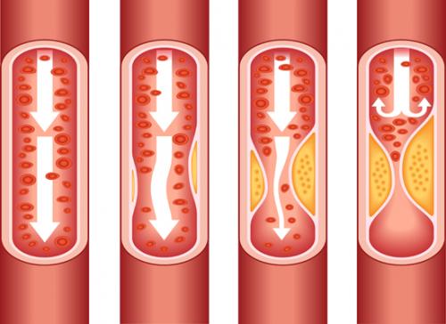  C&oacute;mo destapar sus arterias y evitar enfermedades cardiovasculares 